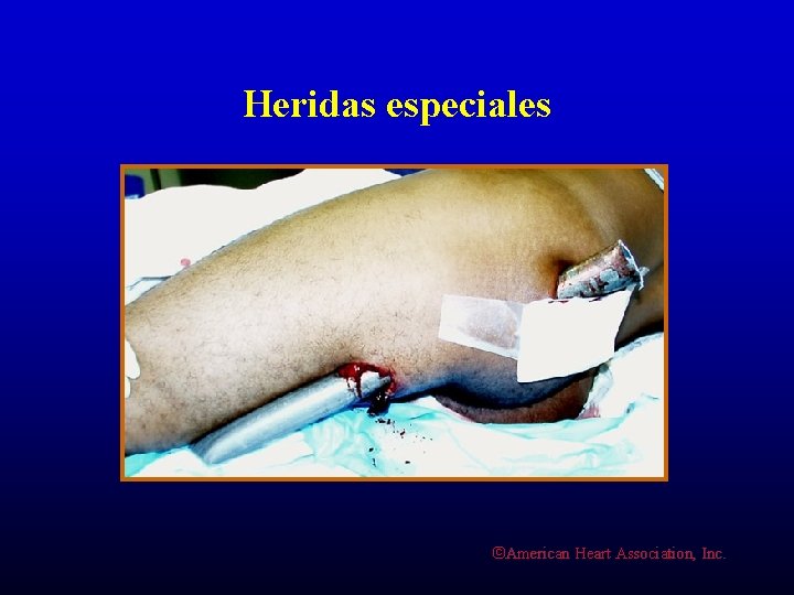 Heridas especiales ©American Heart Association, Inc. 