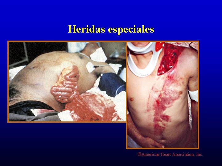 Heridas especiales ©American Heart Association, Inc. 
