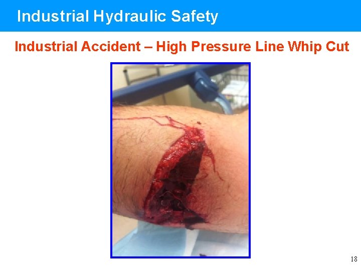 Industrial Hydraulic Safety Industrial Accident – High Pressure Line Whip Cut 18 