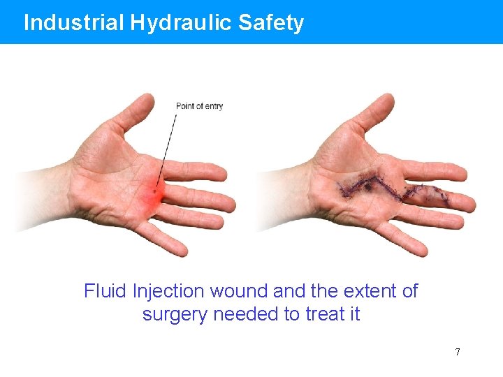 Industrial Hydraulic Safety Fluid Injection wound and the extent of surgery needed to treat