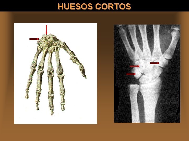 HUESOS CORTOS 