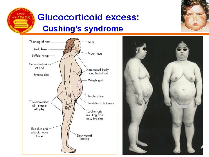 Glucocorticoid excess: Cushing’s syndrome 