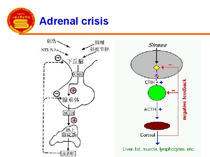 Adrenal crisis 