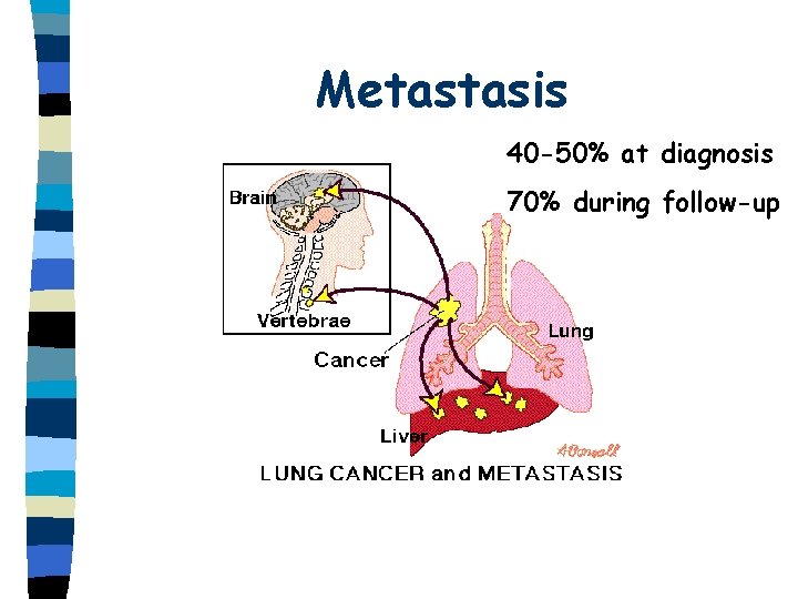 Metastasis 40 -50% at diagnosis 70% during follow-up 