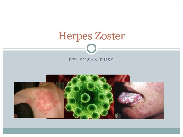 Herpes Zoster BY: SUSAN BUSS 