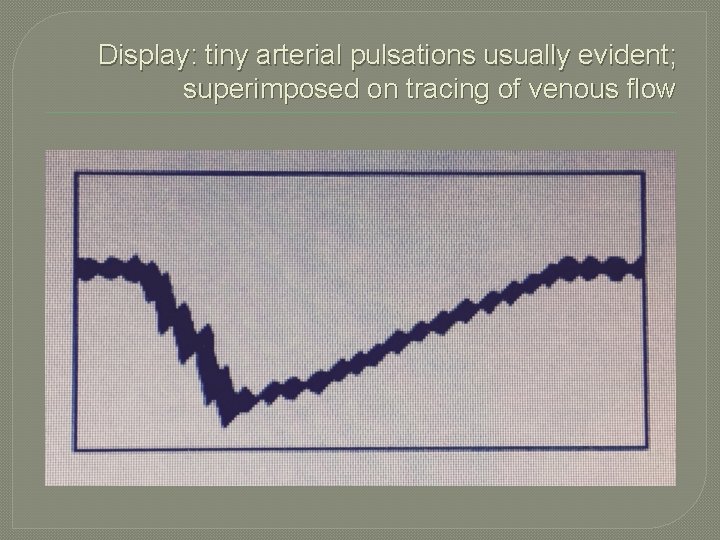 Display: tiny arterial pulsations usually evident; superimposed on tracing of venous flow 