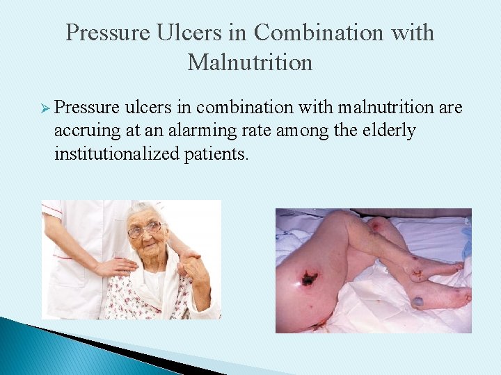 Pressure Ulcers in Combination with Malnutrition Ø Pressure ulcers in combination with malnutrition are