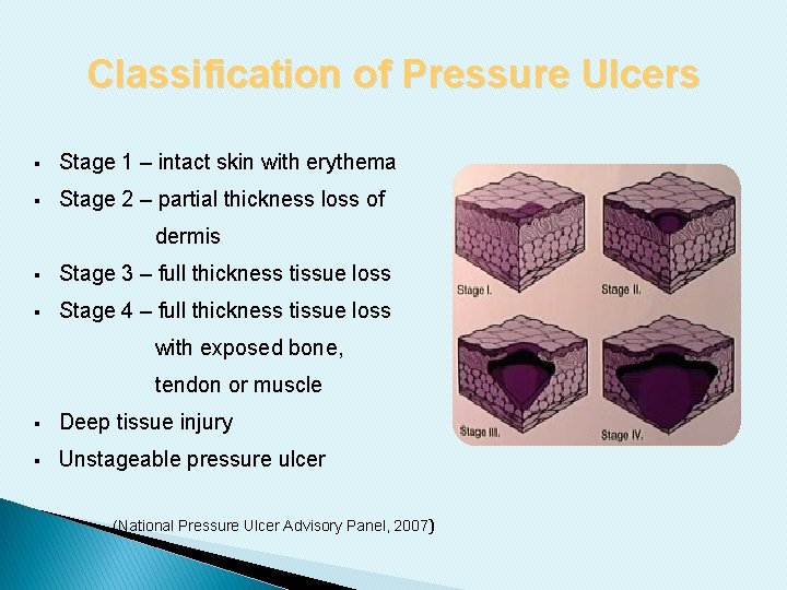 Classification of Pressure Ulcers § Stage 1 – intact skin with erythema § Stage