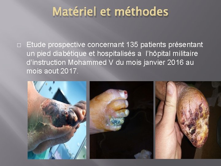 Matériel et méthodes � Etude prospective concernant 135 patients présentant un pied diabétique et