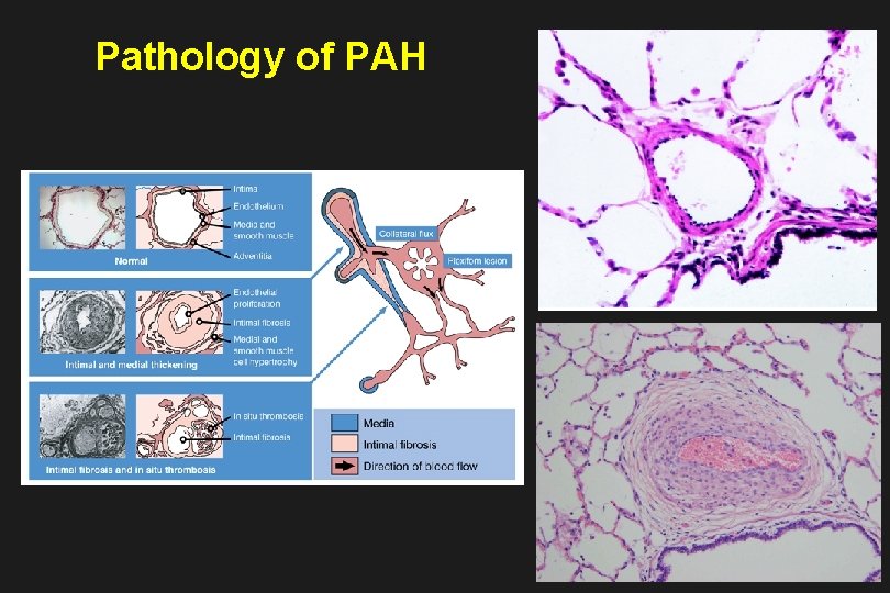 Pathology of PAH 