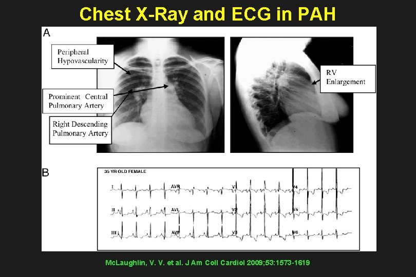 Chest X-Ray and ECG in PAH Mc. Laughlin, V. V. et al. J Am