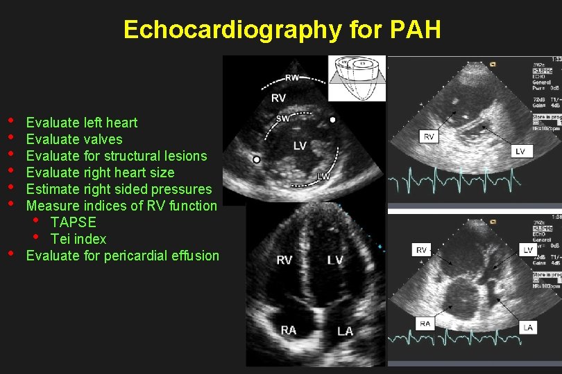Echocardiography for PAH • • Evaluate left heart Evaluate valves Evaluate for structural lesions