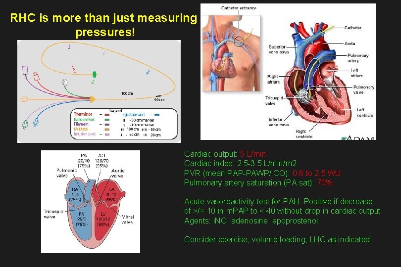 RHC is more than just measuring pressures! Cardiac output: 5 L/min Cardiac index: 2.