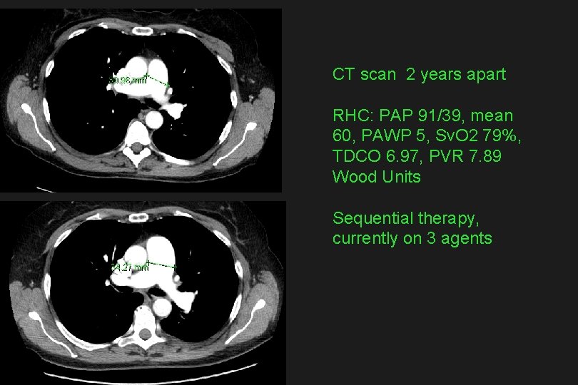 CT scan 2 years apart RHC: PAP 91/39, mean 60, PAWP 5, Sv. O