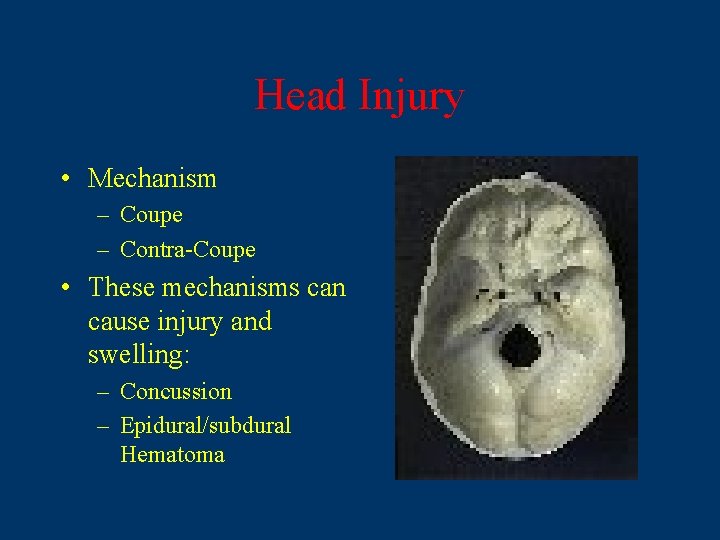 Head Injury • Mechanism – Coupe – Contra-Coupe • These mechanisms can cause injury