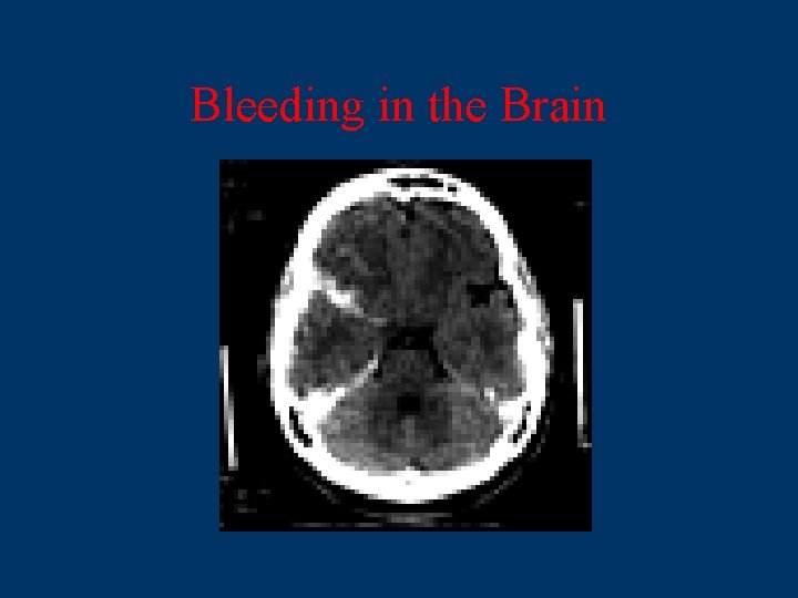 Bleeding in the Brain 