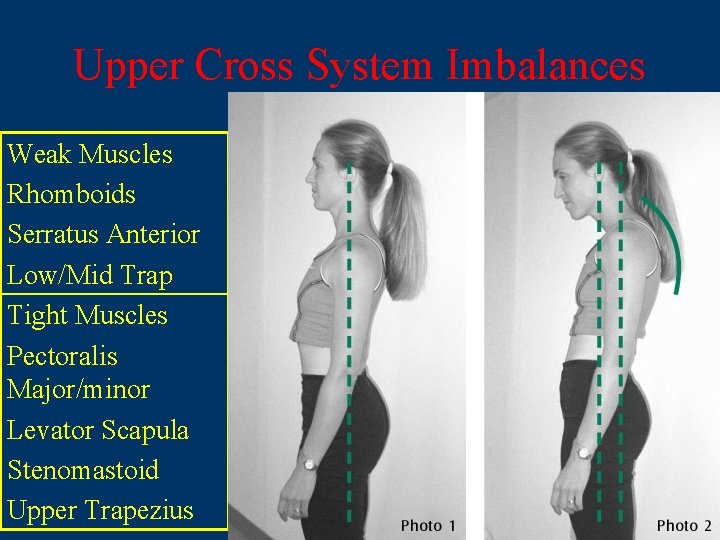 Upper Cross System Imbalances Weak Muscles Rhomboids Serratus Anterior Low/Mid Trap Tight Muscles Pectoralis