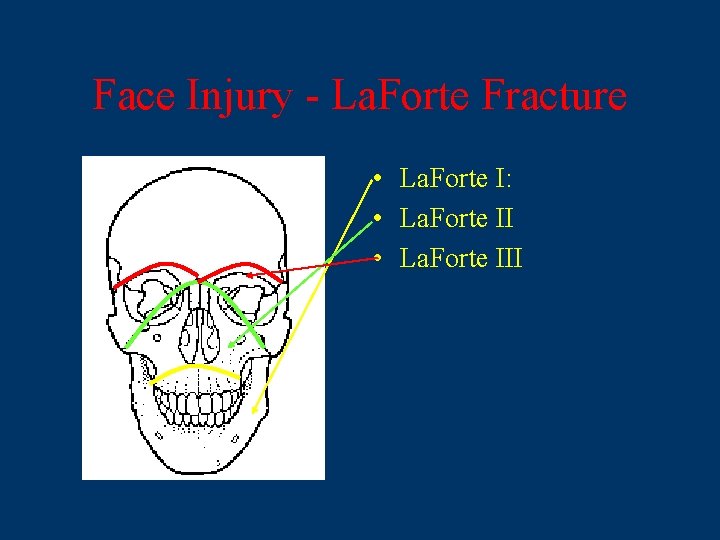 Face Injury - La. Forte Fracture • La. Forte I: • La. Forte III