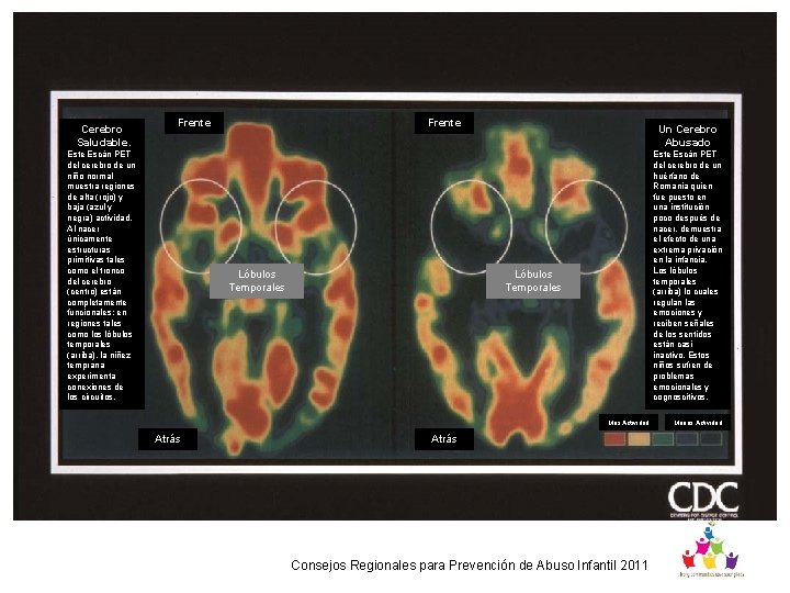 Cerebro Saludable. Frente Escán PET del cerebro de un niño normal muestra regiones de