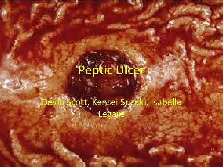 Peptic Ulcer Devin Scott, Kensei Suzuki, Isabelle Legare 