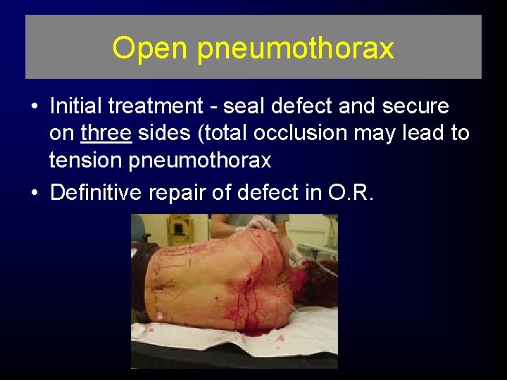 Open pneumothorax • Initial treatment - seal defect and secure on three sides (total