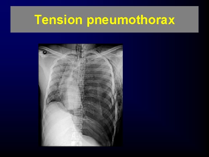 Tension pneumothorax 