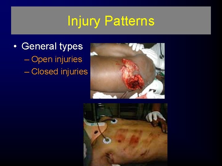 Injury Patterns • General types – Open injuries – Closed injuries 