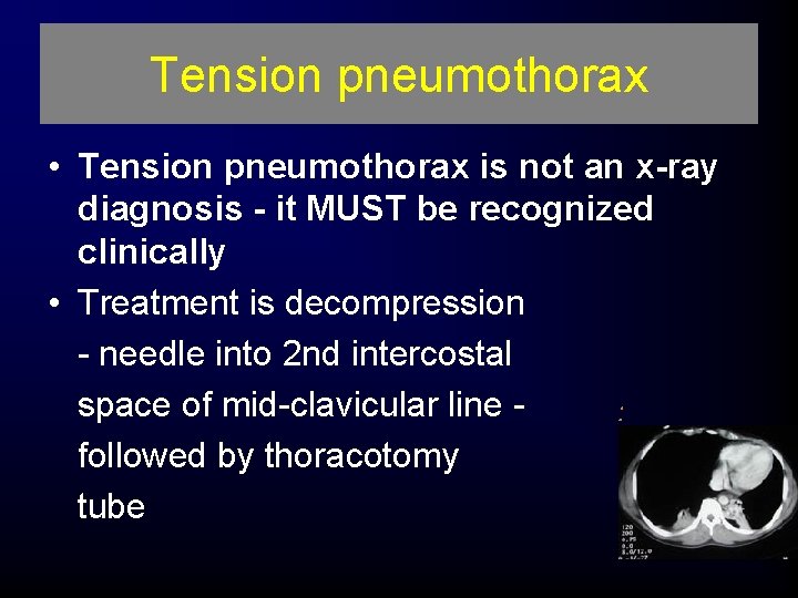 Tension pneumothorax • Tension pneumothorax is not an x-ray diagnosis - it MUST be