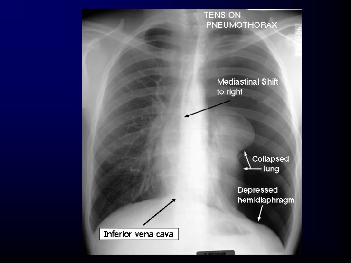 Inferior vena cava 