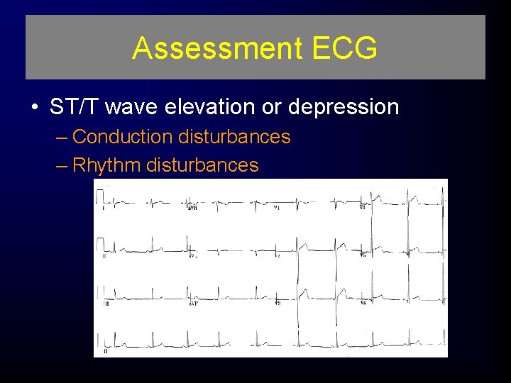Assessment ECG • ST/T wave elevation or depression – Conduction disturbances – Rhythm disturbances