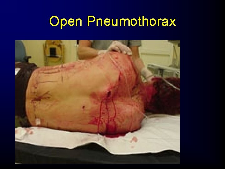Open Pneumothorax 