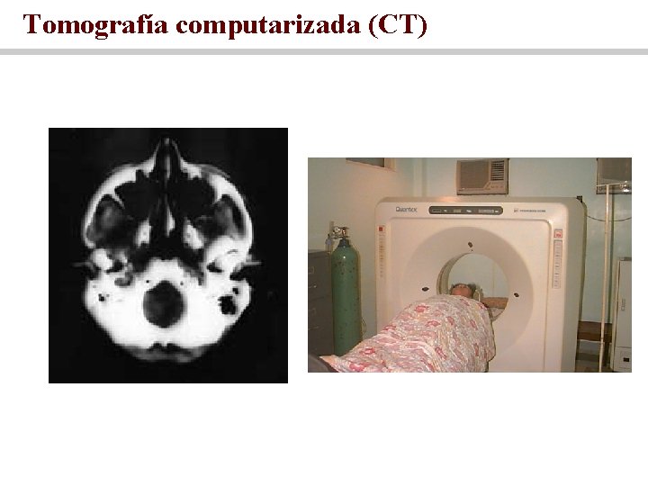 Tomografía computarizada (CT) 