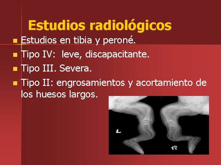 Estudios radiológicos Estudios en tibia y peroné. n Tipo IV: leve, discapacitante. n Tipo