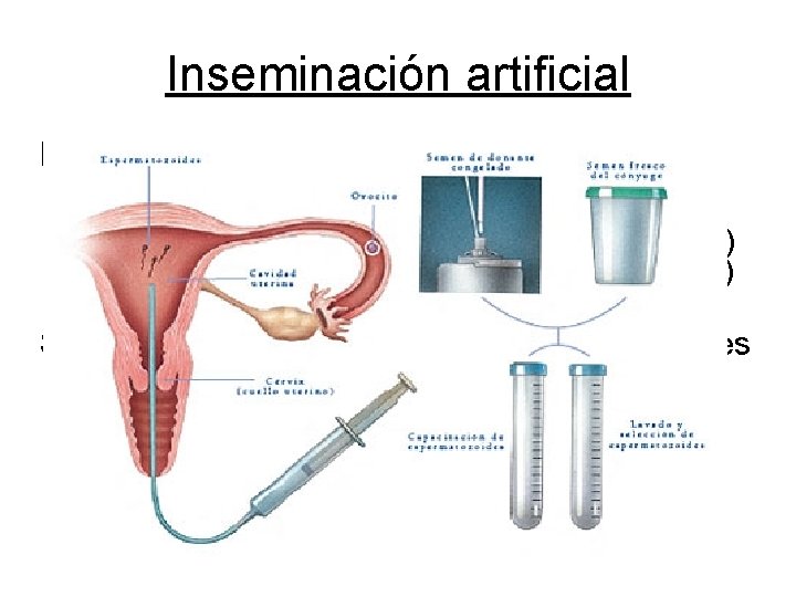 Inseminación artificial La Inseminacion Artificial es un procedimiento de fertilización en el que se