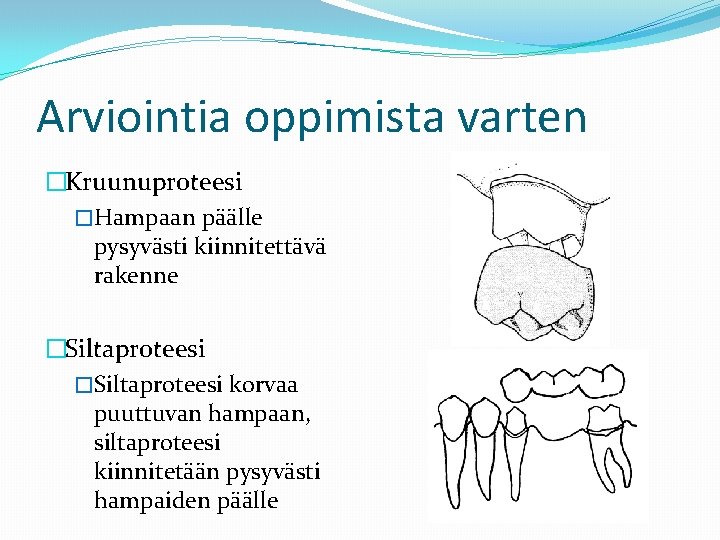 Arviointia oppimista varten �Kruunuproteesi �Hampaan päälle pysyvästi kiinnitettävä rakenne �Siltaproteesi korvaa puuttuvan hampaan, siltaproteesi