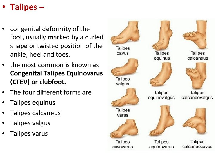 • Talipes – • congenital deformity of the foot, usually marked by a
