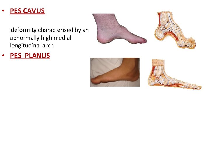  • PES CAVUS deformity characterised by an abnormally high medial longitudinal arch •
