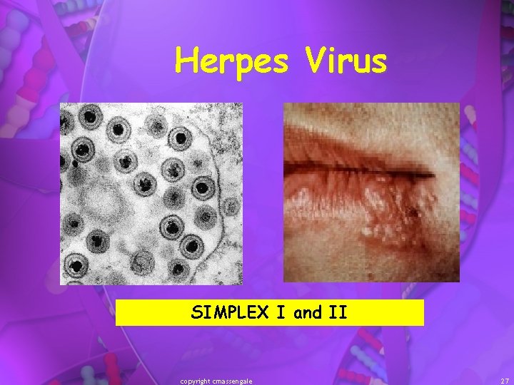 Herpes Virus SIMPLEX I and II copyright cmassengale 27 