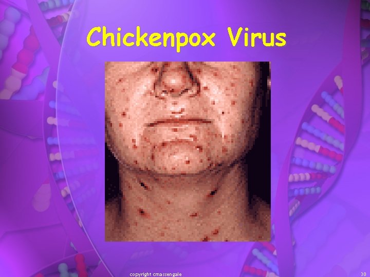 Chickenpox Virus copyright cmassengale 30 