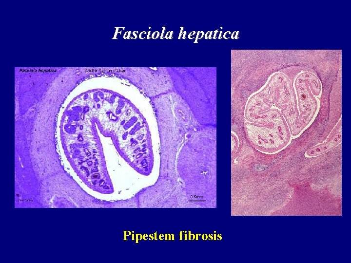 Fasciola hepatica Pipestem fibrosis 