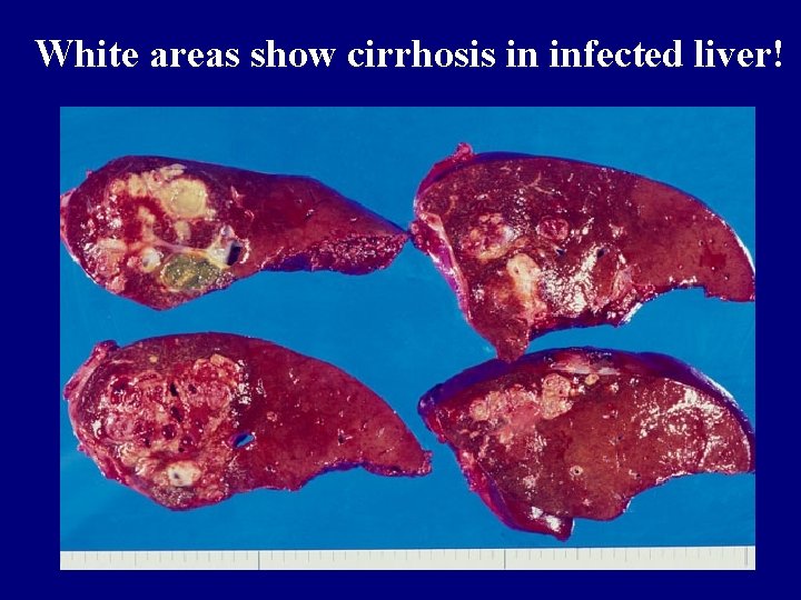 White areas show cirrhosis in infected liver! 
