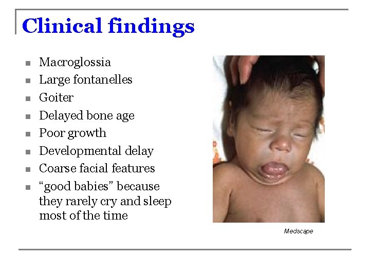 Clinical findings n n n n Macroglossia Large fontanelles Goiter Delayed bone age Poor