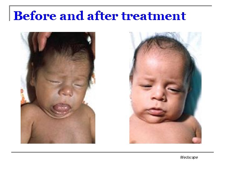 Before and after treatment Medscape 