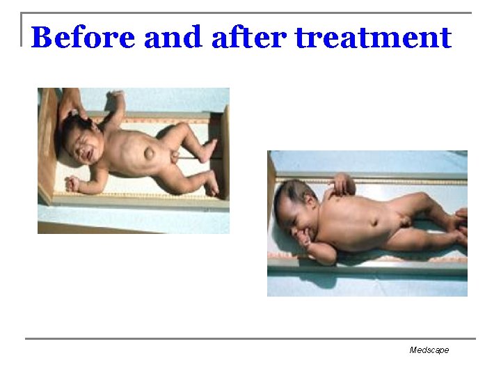 Before and after treatment Medscape 