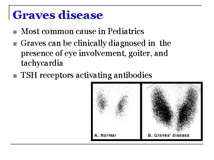 Graves disease n n n Most common cause in Pediatrics Graves can be clinically