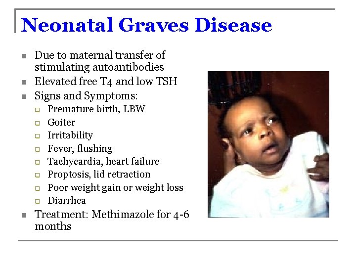 Neonatal Graves Disease n n n Due to maternal transfer of stimulating autoantibodies Elevated