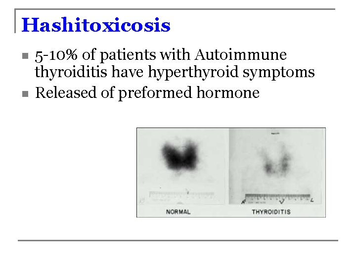 Hashitoxicosis n n 5 -10% of patients with Autoimmune thyroiditis have hyperthyroid symptoms Released