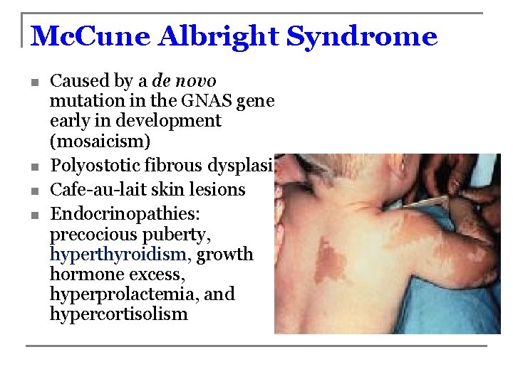 Mc. Cune Albright Syndrome n n Caused by a de novo mutation in the