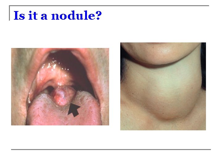 Is it a nodule? 