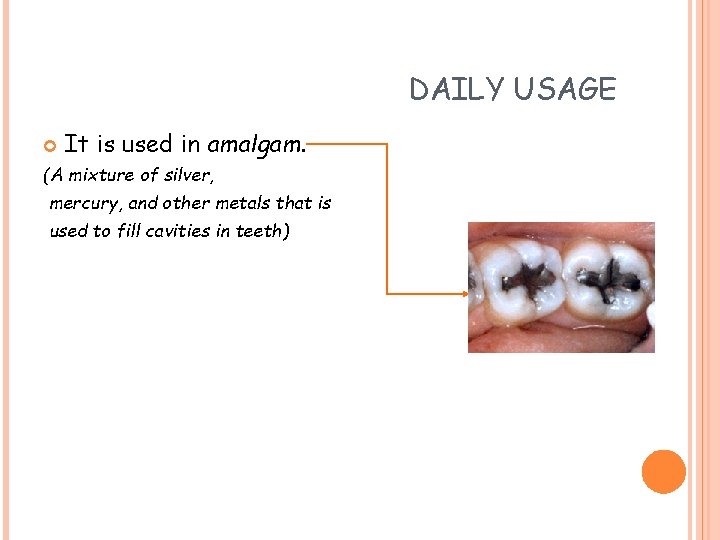 DAILY USAGE It is used in amalgam. (A mixture of silver, mercury, and other